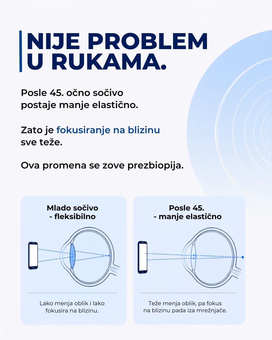 Ilustracija koja objašnjava zašto sočivo gubi elastičnost i nastaje prezbiopija